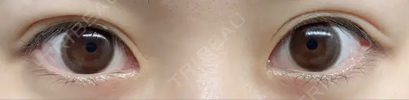 二重埋没 城本クリニック 姫路院 AFTER メイン用