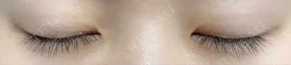 二重埋没 城本クリニック 姫路院 DAY 183 メイン用