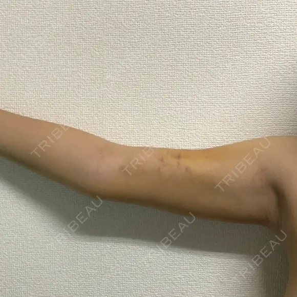 脂肪吸引（二の腕） ドクターフィット（Dr.fit）クリニック DAY 5 メイン用