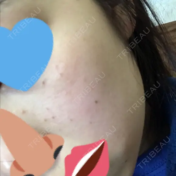 美肌レーザー / シミ取りレーザー / 美白レーザー 銀座みゆき通り美容外科 大阪梅田院 DAY 2 メイン用
