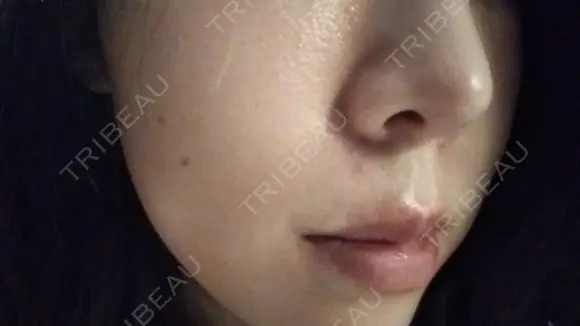 ピーリング（ニキビ・毛穴） / イオン導入 メディアージュクリニック 青山院 DAY 0 メイン用