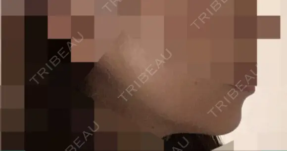 骨切り（あご） / 骨削り（エラ） / 骨削り（頬） ボンディ美容整形外科（旧リオン整形外科） DAY 119 メイン用