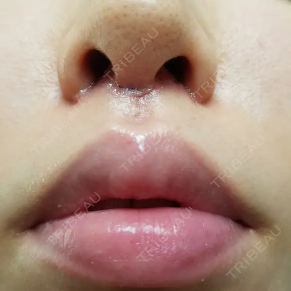 人中短縮 CLASSY 仙台美容外科・美容皮膚科 DAY 8 メイン用