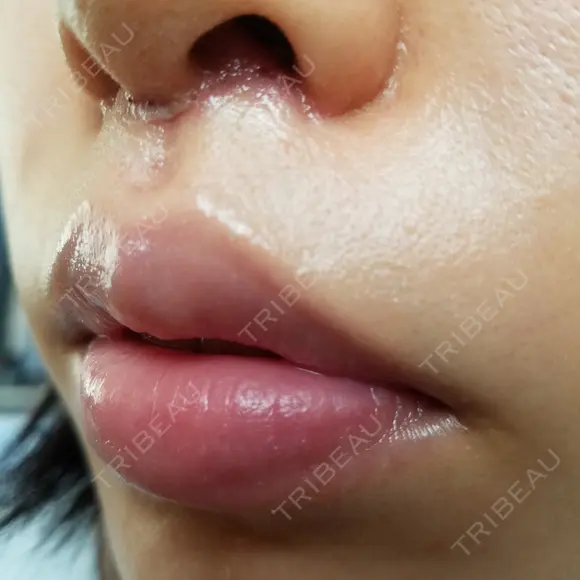 人中短縮 CLASSY 仙台美容外科・美容皮膚科 DAY 8 メイン用