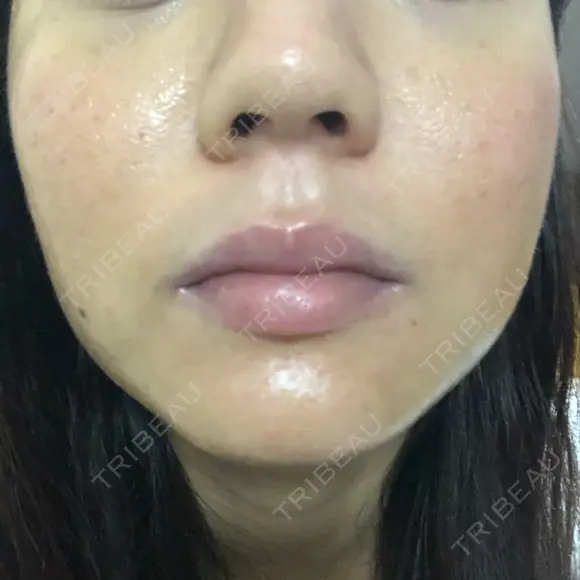 ニキビ治療 たにまちクリニック DAY 154 メイン用