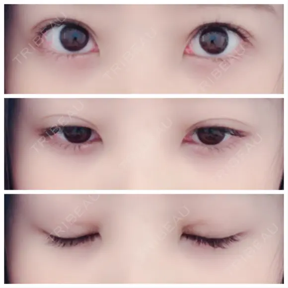 二重埋没 / 眼瞼下垂（切開） / クマ治療 / 下まぶたの脂肪取り THE MEDICAL SALON DAY 35 メイン用