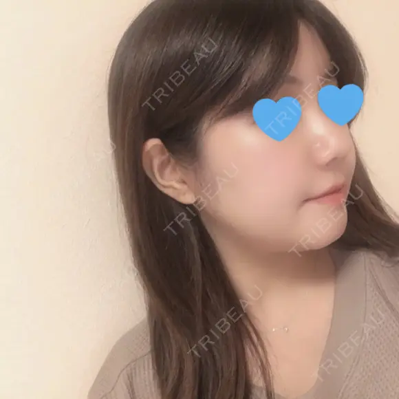 骨切り（あご） / 骨削り（エラ） / 骨削り（頬） / 脂肪吸引（顔） / 脂肪注入（額） / 脂肪溶解注射（顔） View美容整形外科 DAY 37 メイン用