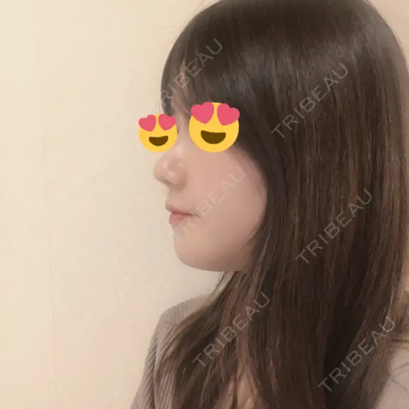 骨切り（あご） / 骨削り（エラ） / 骨削り（頬） / 脂肪吸引（顔） / 脂肪注入（額） / 脂肪溶解注射（顔） View美容整形外科 DAY 37 メイン用