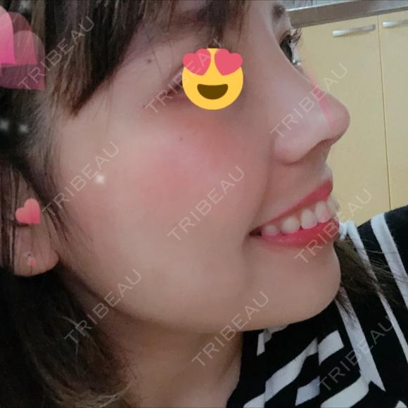 隆鼻術 / 鼻尖形成（切開） / 鼻中隔延長（切開） / 眉間プロテーゼ FROM B整形外科 (旧バウム整形外科) DAY 10 メイン用
