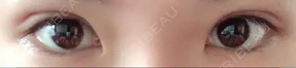 二重埋没 / 上まぶたの脂肪取り TCB東京中央美容外科 江坂院 DAY 24 メイン用