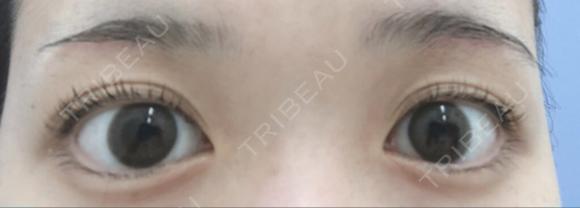 その他（目元） / 眉下切開 湘南美容クリニック 秋葉原院 DAY 94 メイン用