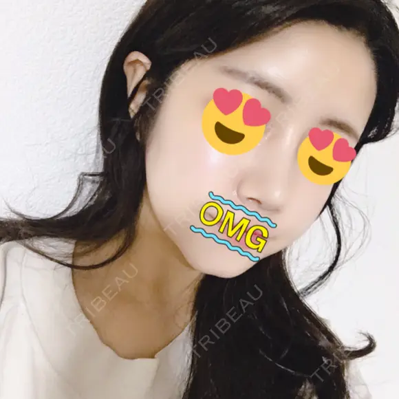 骨切り（あご） / 骨削り（エラ） / 骨削り（頬） / 脂肪吸引（顔） / 脂肪注入（額） / 脂肪溶解注射（顔） View美容整形外科 DAY 95 メイン用