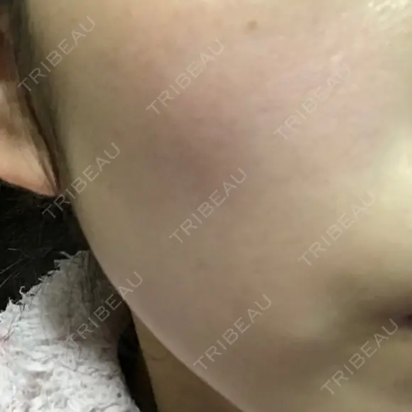美肌レーザー / シミ取りレーザー / 美白レーザー 銀座みゆき通り美容外科 大阪梅田院 AFTER メイン用