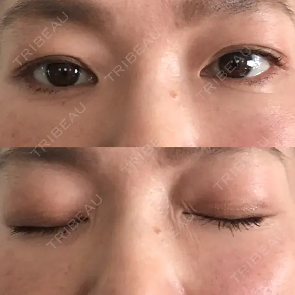 下まぶたたるみ取り セオリークリニック DAY 14 メイン用