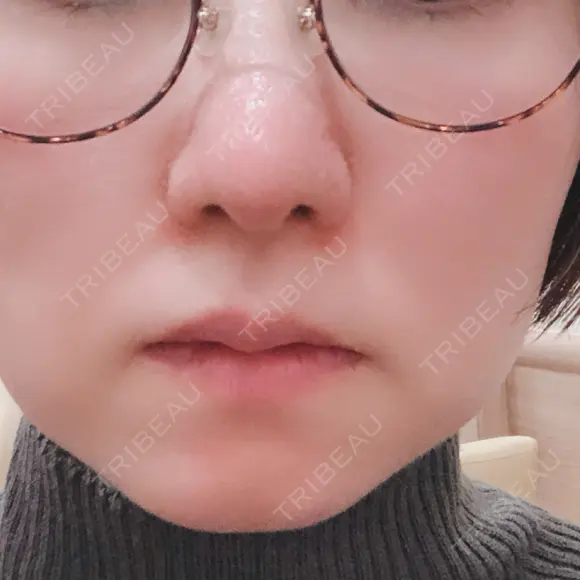 小鼻縮小（切開） / 鼻尖縮小 表参道スキンクリニック 表参道院 DAY 75 メイン用