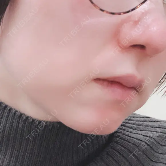 小鼻縮小（切開） / 鼻尖縮小 表参道スキンクリニック 表参道院 DAY 75 メイン用