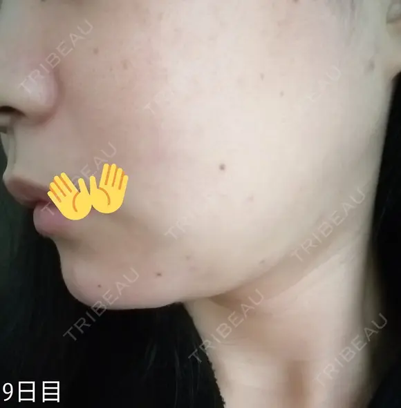 ボトックス（あご） / 肌ヒアルロン酸注入（たるみ・シワ改善） / 美容点滴・美容注射（美肌） / イオン導入 / 美肌レーザー / ニキビ治療 ラミチェ美容整形外科 DAY 9 メイン用