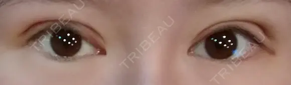 眼瞼下垂（切開） / 隆鼻術 / 鼻尖形成（切開） / 鼻中隔延長（切開） / 軟骨移植 アネシス美容クリニック DAY 8 メイン用