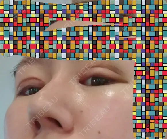 眼瞼下垂（切開） / 隆鼻術 / 鼻尖形成（切開） / 鼻中隔延長（切開） / 軟骨移植 アネシス美容クリニック DAY 8 メイン用