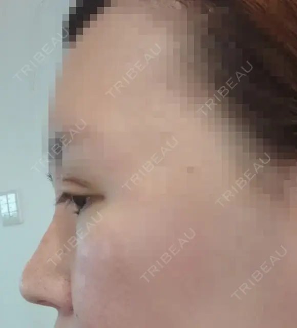 眼瞼下垂（切開） / 隆鼻術 / 鼻尖形成（切開） / 鼻中隔延長（切開） / 軟骨移植 アネシス美容クリニック DAY 8 メイン用