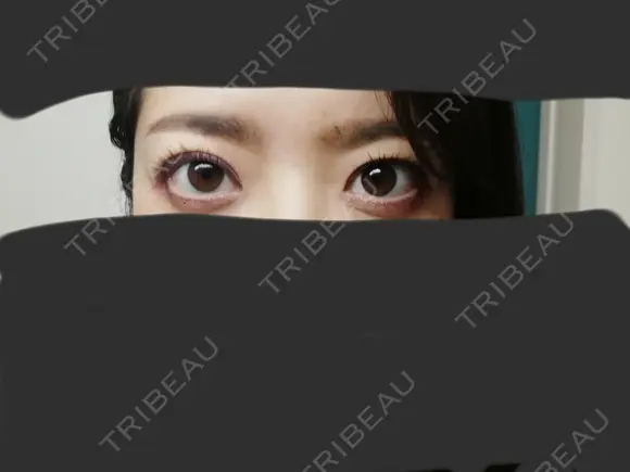 二重埋没 / 小鼻縮小（切開） / その他（鼻） / 骨切り（あご） / 軟骨移植 バノバギ整形外科 DAY 15 メイン用
