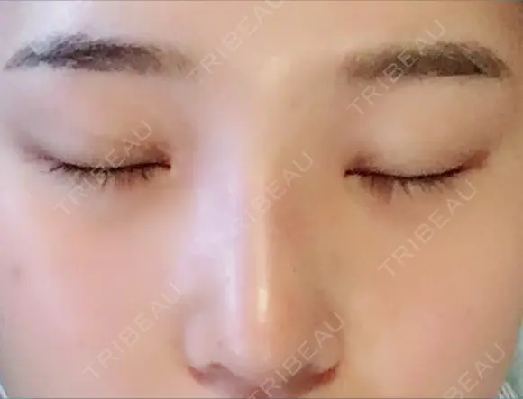 隆鼻術 / 鼻尖形成（切開） / 小鼻縮小（切開） / 軟骨移植 / 骨切幅寄せ / ワシ鼻修正・ハンプ切除 ザ・プラス美容外科 DAY 35 メイン用