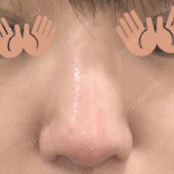 小鼻縮小（切開） 東京ヒルズクリニック 新宿院 DAY 73 メイン用