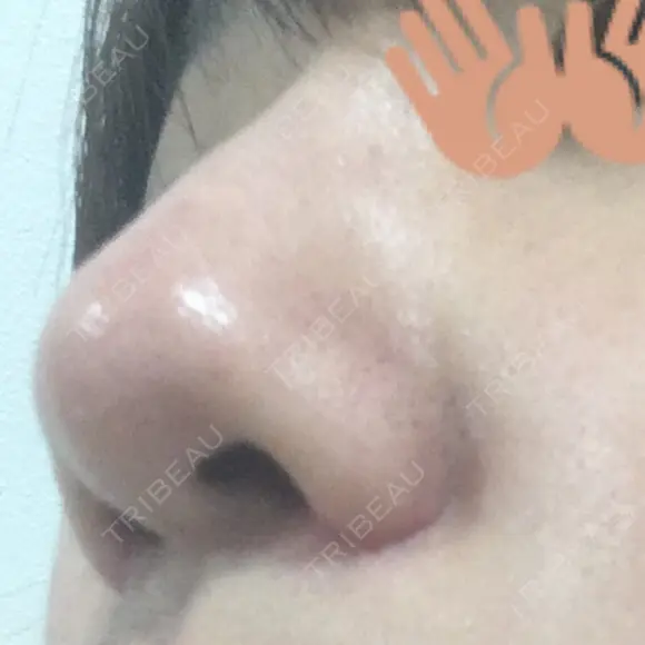 小鼻縮小（切開） 東京ヒルズクリニック 新宿院 DAY 73 メイン用