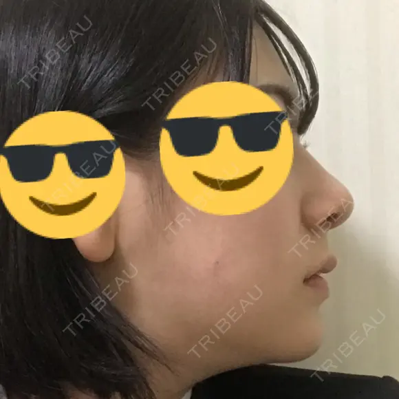 鼻尖形成（切開） / 鼻中隔延長（切開） / 小鼻縮小（切開） / 軟骨移植 / ワシ鼻修正・ハンプ切除 / 鼻尖縮小 カイ整形外科・皮膚科 DAY 8 メイン用