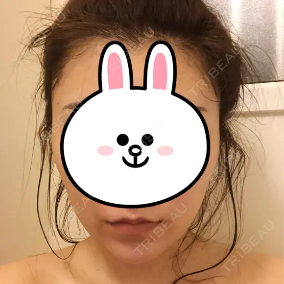 ボトックス（あご） / 脂肪溶解注射（顔） クリニックA.O. AFTER メイン用