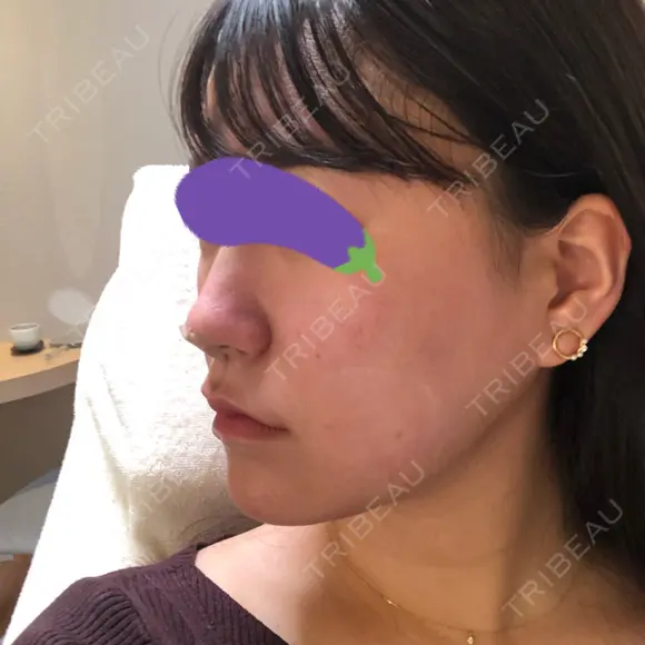 スレッドノーズ Beauty Clinic the GINZA DAY 0 メイン用
