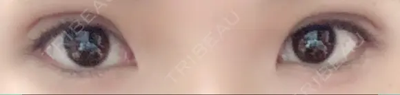 二重埋没 / 上まぶたの脂肪取り TCB東京中央美容外科 江坂院 AFTER メイン用