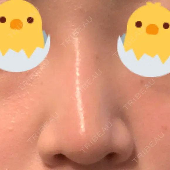 鼻尖形成（切開） / 鼻尖縮小 / ヒアルロン酸注入（鼻） 東京ヒルズクリニック 新宿院 DAY 6 メイン用