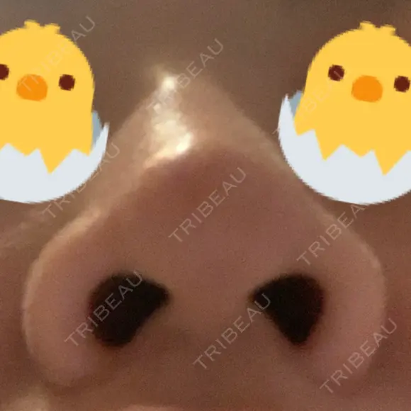 鼻尖形成（切開） / 鼻尖縮小 / ヒアルロン酸注入（鼻） 東京ヒルズクリニック 新宿院 DAY 6 メイン用