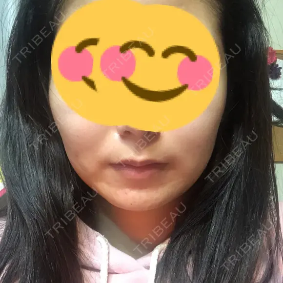 骨削り（エラ） / 骨削り（頬） / 脂肪吸引（顔） View美容整形外科 DAY 60 メイン用