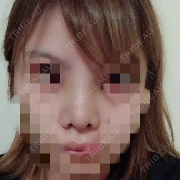 鼻尖形成（切開） / 小鼻縮小（切開） / 軟骨移植 / 眉間プロテーゼ 湘南美容クリニック 広島院 DAY 9 メイン用