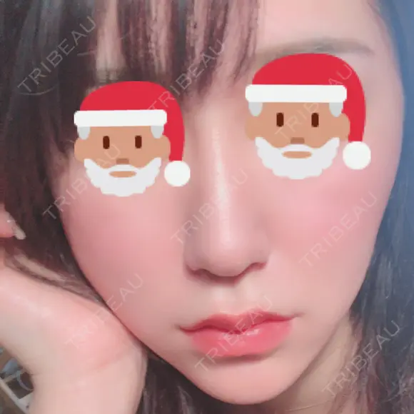 スレッドノーズ Beauty Clinic the GINZA DAY 1 メイン用