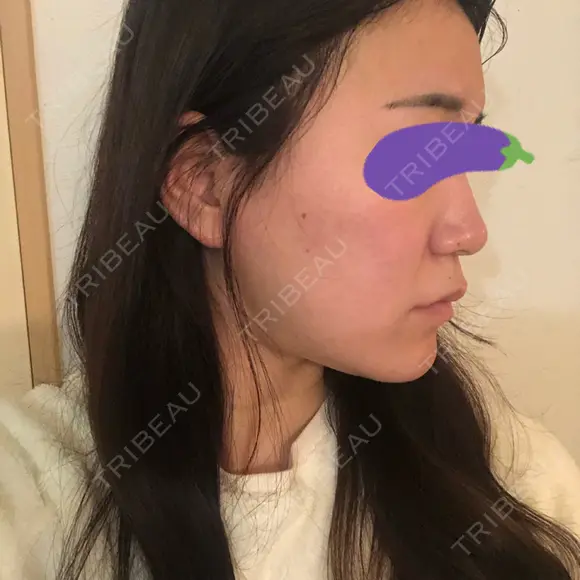 スレッドノーズ Beauty Clinic the GINZA AFTER メイン用