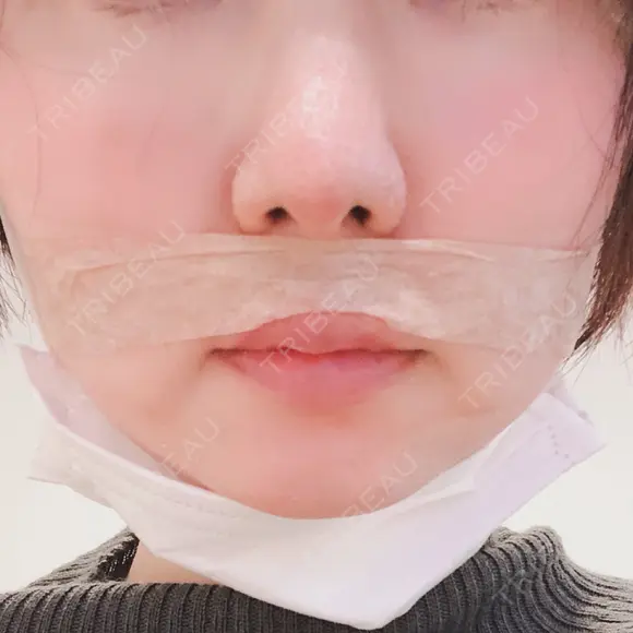 小鼻縮小（切開） / 鼻尖縮小 表参道スキンクリニック 表参道院 DAY 81 メイン用