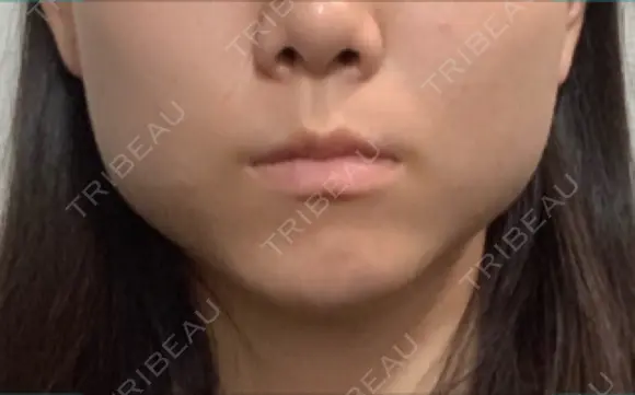 ボトックス（エラ・小顔） / 脂肪溶解注射（顔） コスメディカルクリニック シンシア 銀座院 DAY 2 メイン用