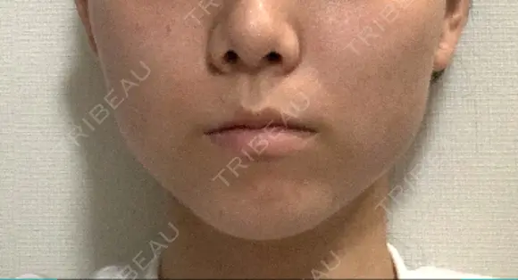 ボトックス（エラ・小顔） / 脂肪溶解注射（顔） コスメディカルクリニック シンシア 銀座院 DAY 23 メイン用