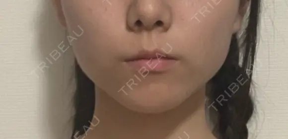 ボトックス（エラ・小顔） / 脂肪溶解注射（顔） コスメディカルクリニック シンシア 銀座院 DAY 29 メイン用