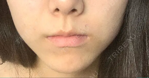 ボトックス（エラ・小顔） / 脂肪溶解注射（顔） コスメディカルクリニック シンシア 銀座院 DAY 37 メイン用