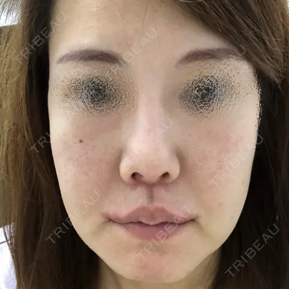 人中短縮 / 口角挙上 清潭女神美容外科 DAY 33 メイン用