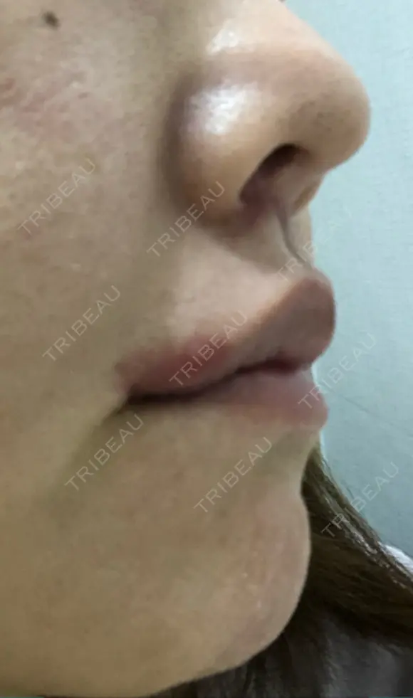 人中短縮 / 口角挙上 清潭女神美容外科 DAY 33 メイン用