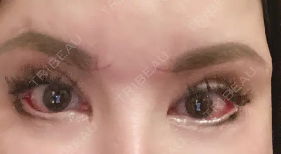眼瞼下垂（切開） / クマ治療 / 目尻切開 / 下まぶたたるみ取り / 下まぶたの脂肪取り / タレ目形成・グラマラスライン（切開） / 眉下切開 id（アイディ）美容外科 DAY 16 メイン用