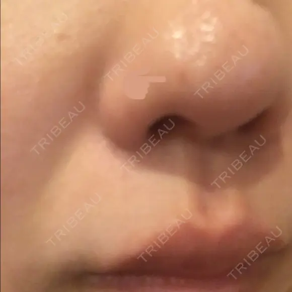 ほくろ・いぼ切除（肌） Mスキンクリニック DAY 13 メイン用