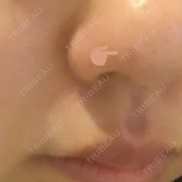 ほくろ・いぼ切除（肌） Mスキンクリニック DAY 28 メイン用