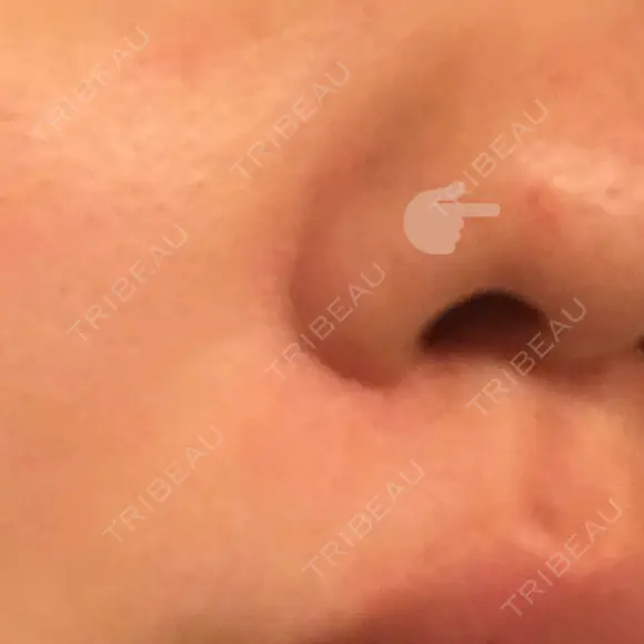 ほくろ・いぼ切除（肌） Mスキンクリニック DAY 47 メイン用
