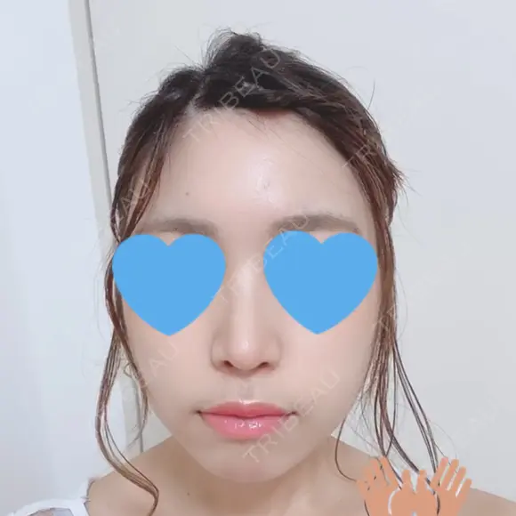 鼻中隔延長（切開） / 軟骨移植 / 鼻尖縮小 HANABI整形外科 DAY 62 メイン用